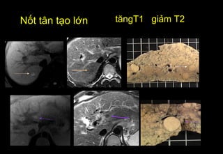 tăngT1 giảm T2Nốt tân tạo lớn
 