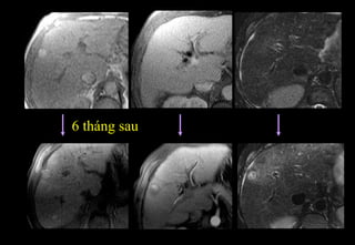 6 tháng sau
 
