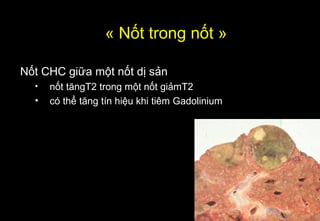 « Nốt trong nốt »
Nốt CHC giữa một nốt dị sản
• nốt tăngT2 trong một nốt giảmT2
• có thể tăng tín hiệu khi tiêm Gadolinium
 