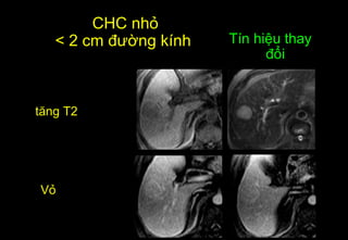 CHC nhỏ
< 2 cm đường kính
Vỏ
Tín hiệu thay
đổi
tăng T2
 