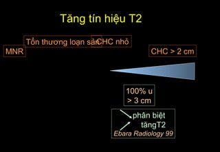 CHC nhỏ
CHC > 2 cmMNR
Tổn thương loạn sản
Tăng tín hiệu T2
100% u
> 3 cm
phân biệt
tăngT2
Ebara Radiology 99
 