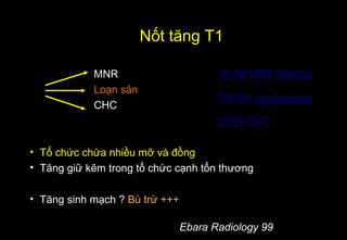 Nốt tăng T1
MNR
Loạn sản
CHC
• Tổ chức chứa nhiều mỡ và đồng
• Tăng giữ kẽm trong tổ chức cạnh tổn thương
• Tăng sinh mạch ? Bù trừ +++
Ebara Radiology 99
42 /58 MNR détectés
7/9 MN dysplasiques
25/29 CHC
Hopital CROIX ROUSSE
 