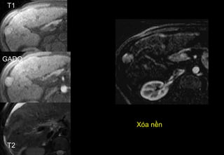 Xóa nền
T1
GADO
T2
 