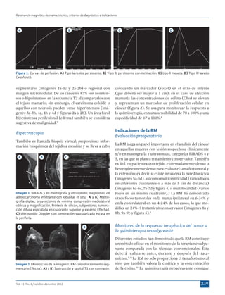 Resonancia magnética de mama: técnica, criterios de diagnóstico e indicaciones

A

B

C

D

Figura 1. Curvas de perfusión. A) Tipo Ia realce persistente. B) Tipo Ib persistente con inclinación. C) tipo II meseta. D) Tipo III lavado
(washout).

segmentario (imágenes 1a-1c y 2a-2b) o regional con
margen micronodular. De los cánceres 87% son isointensos o hipointensos en la secuencia T2 al compararlos con
el tejido mamario; sin embargo, el carcinoma coloide o
aquellos con necrosis pueden verse hiperintensos (imágenes 3a-3b, 4a, 4b y 4d y figuras 2a y 2b). Un área focal
hiperintensa perilesional (edema) también se considera
sugestiva de malignidad.7

Indicaciones de la RM
Evaluación preoperatoria

Espectroscopia
También es llamada biopsia virtual; proporciona información bioquímica del tejido a estudiar y se lleva a cabo
A

B

C

Imagen 1. BIRADS 5 en mastografía y ultrasonido; diagnóstico de
adenocarcinoma infiltrante con lobulillar in situ. A y B) Mastografía digital, proyecciones de mínima compresión mediolateral
oblicua y magnificación. Prótesis de silicón, subpectoral; tumoración difusa espiculada en cuadrante superior y externo (flecha).
C) Ultrasonido Doppler con tumoración vascularizada escasa en
la periferia.
A

B

Imagen 2. Mismo caso de la imagen 1. RM con reforzamiento segmentario (flecha). A) y B) Sustracción y sagital T1 con contraste.

Vol. 11 No. 4 / octubre-diciembre 2012

colocando un marcador (voxel) en el sitio de interés
(que deberá ser mayor a 1  cm); en el caso de afección
mamaria las concentraciones de colina (Cho) se elevan
y representan un marcador de proliferación celular en
cáncer (figura 3). Se usa para monitorear la respuesta a
la quimioterapia, con una sensibilidad de 70 a 100% y una
especificidad de 67 a 100%.8

La RM juega un papel importante en el análisis del cáncer
en aquellas mujeres con lesión sospechosa clínicamente
y/o en mastografía y ultrasonido, categorías BIRADS 4 y
5, en las que se planea tratamiento conservador. También
es útil en pacientes con tejido extremadamente denso o
heterogéneamente denso para evaluar el tamaño tumoral y
la extensión; es decir, si existe invasión a la pared torácica
(imágenes 5a-5d), así como multicentricidad (varios focos
en diferentes cuadrantes o a más de 5 cm de distancia)
(imágenes 6a-6c, 7a-7d y figura 4) o multifocalidad (varios
focos en un mismo cuadrante).2 La RM ha demostrado
otros focos tumorales en la mama ipsilateral en 6-34% y
en la contralateral en un 4-24% de los casos, lo que modifica en 24% el tratamiento conservador (imágenes 8a y
8b, 9a-9c y figura 5).9

Monitoreo de la respuesta terapéutica del tumor a
la quimioterapia neoadyuvante
Diferentes estudios han demostrado que la RM constituye
un método eficaz en el monitoreo de la terapia neoadyuvante comparada con las técnicas convencionales. Ésta
deberá realizarse antes, durante y después del tratamiento.1,10 La RM no solo proporciona el tamaño tumoral
sino que también valora la cinética y la concentración
de la colina.10 La quimioterapia neoadyuvante consigue

239

 