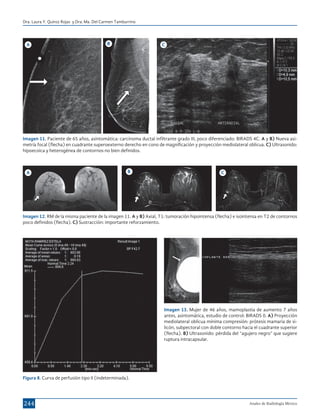 Dra. Laura Y. Quiroz Rojas y Dra. Ma. Del Carmen Tamburrino

A

B

C

Imagen 11. Paciente de 65 años, asintomática: carcinoma ductal infiltrante grado III, poco diferenciado: BIRADS 4C. A y B) Nueva asimetría focal (flecha) en cuadrante superoexterno derecho en cono de magnificación y proyección mediolateral oblicua. C) Ultrasonido:
hipoecoica y heterogénea de contornos no bien definidos.

A

B

C

Imagen 12. RM de la misma paciente de la imagen 11. A y B) Axial, T1: tumoración hipointensa (flecha) e isointensa en T2 de contornos
poco definidos (flecha). C) Sustracción: importante reforzamiento.

Imagen 13. Mujer de 46 años, mamoplastia de aumento 7 años
antes, asintomática, estudio de control: BIRADS 0. A) Proyección
mediolateral oblicua mínima compresión: prótesis mamaria de silicón, subpectoral con doble contorno hacia el cuadrante superior
(flecha). B) Ultrasonido: pérdida del “agujero negro” que sugiere
ruptura intracapsular.

Figura 8. Curva de perfusión tipo II (indeterminada).

244

Anales de Radiología México

 