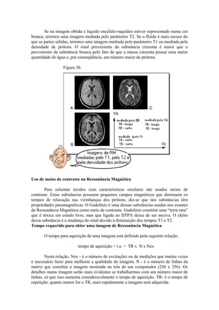 Se na imagem obtida o líquido encéfalo-raquídeo estiver representado numa cor
branca, teremos uma imagem mediada pelo parâmetro T2. Se o fluído é mais escuro do
que as partes sólidas, teremos uma imagem mediada pelo parâmetro T1 ou mediada pela
densidade de prótons. O sinal proveniente da substância cinzenta é maior que o
proveniente da substância branca pelo fato de que a massa cinzenta possui uma maior
quantidade de água e, por conseqüência, um número maior de prótons.
Figura 30.
Uso de meios de contraste na Ressonância Magnética
Para salientar tecidos com características similares são usados meios de
contraste. Estas substâncias possuem pequenos campos magnéticos que diminuem os
tempos de relaxação nas vizinhanças dos prótons; diz-se que tais substâncias têm
propriedades paramagnéticas. O Gadolínio é uma dessas substâncias usadas nos exames
de Ressonância Magnética como meio de contraste. Gadolínio constitui uma “terra rara”
que é tóxica em estado livre, mas que ligada ao DTPA deixa de ser nociva. O efeito
dessa substância é a mudança do sinal devido à diminuição dos tempos T1 e T2 .
Tempo requerido para obter uma imagem de Ressonância Magnética
O tempo para aquisição de uma imagem está definido pela seguinte relação:
tempo de aquisição = t.a. = TR x N x Nex
Nesta relação, Nex - é o número de excitações ou de medições que muitas vezes
é necessário fazer para melhorar a qualidade da imagem; N - é o número de linhas da
matriz que constitui a imagem mostrada na tela de um computador (256 x 256). Os
detalhes numa imagem serão mais evidentes se trabalharmos com um número maior de
linhas, só que isso aumenta consideravelmente o tempo de aquisição. TR- é o tempo de
repetição; quanto menor for o TR, mais rapidamente a imagem será adquirida.
 