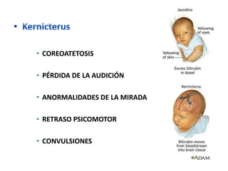 • COREOATETOSIS

• PÉRDIDA DE LA AUDICIÓN

• ANORMALIDADES DE LA MIRADA

• RETRASO PSICOMOTOR

• CONVULSIONES
 