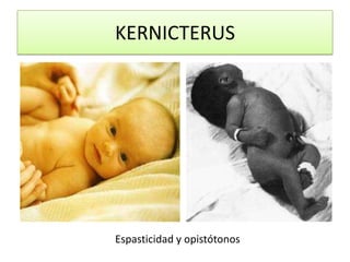 KERNICTERUS




Espasticidad y opistótonos
 