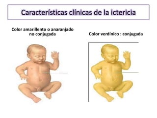 Características clínicas de la ictericia

Color amarillento o anaranjado
        no conjugada             Color verdínico : conjugada
 