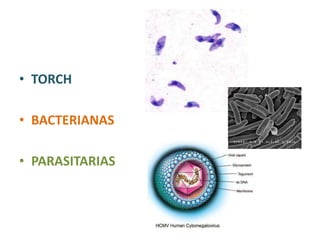 • TORCH

• BACTERIANAS

• PARASITARIAS
 