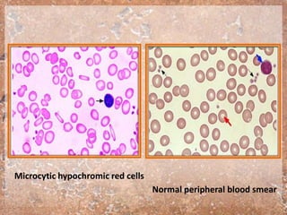 Microcytic hypochromic red cells
Normal peripheral blood smear
 