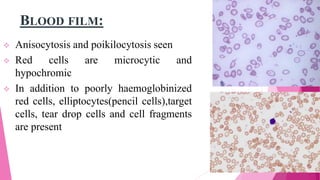 BLOOD FILM:
 Anisocytosis and poikilocytosis seen
 Red cells are microcytic and
hypochromic
 In addition to poorly haemoglobinized
red cells, elliptocytes(pencil cells),target
cells, tear drop cells and cell fragments
are present
 
