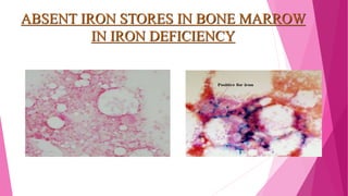 ABSENT IRON STORES IN BONE MARROW
IN IRON DEFICIENCY
 