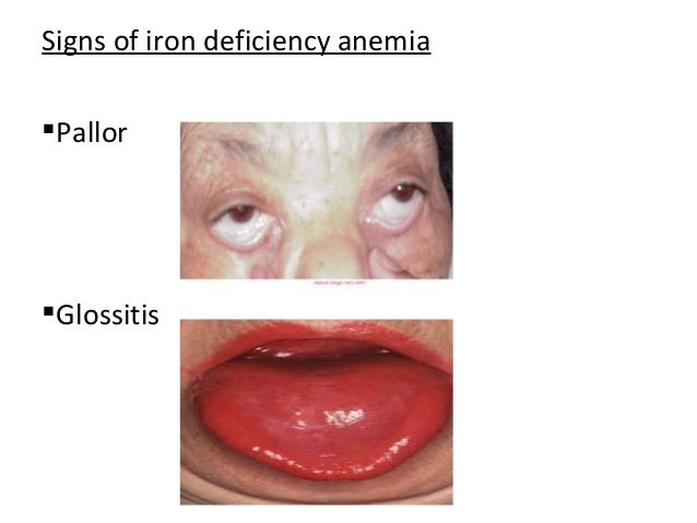 What are some signs of iron deficiency?