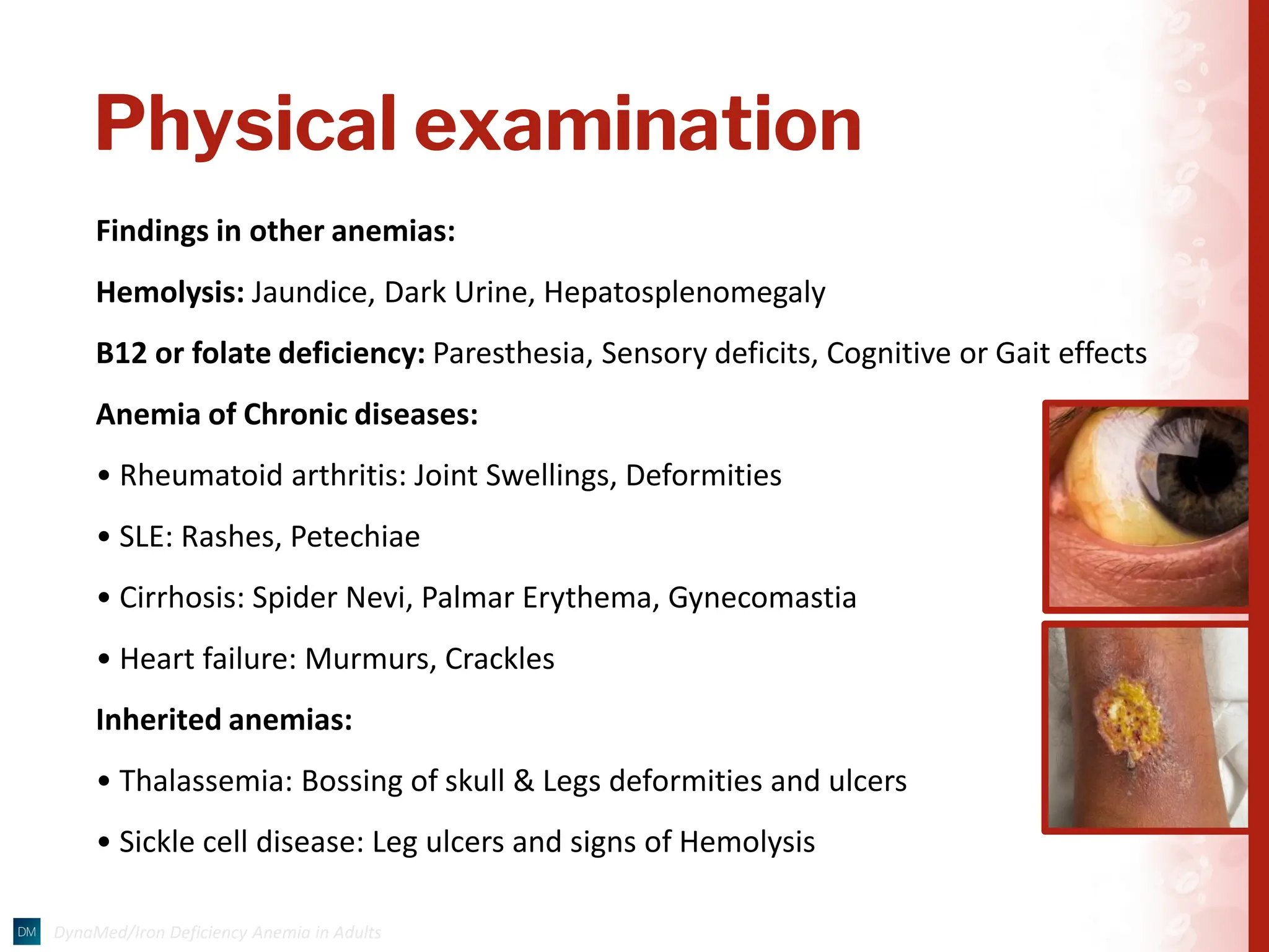 Physical examination
Findings in other anemias:
Hemolysis: Jaundice, Dark Urine, Hepatosplenomegaly
B12 or folate deficiency: Paresthesia, Sensory deficits, Cognitive or Gait effects
Anemia of Chronic diseases:
• Rheumatoid arthritis: Joint Swellings, Deformities
• SLE: Rashes, Petechiae
• Cirrhosis: Spider Nevi, Palmar Erythema, Gynecomastia
• Heart failure: Murmurs, Crackles
Inherited anemias:
• Thalassemia: Bossing of skull & Legs deformities and ulcers
• Sickle cell disease: Leg ulcers and signs of Hemolysis
 