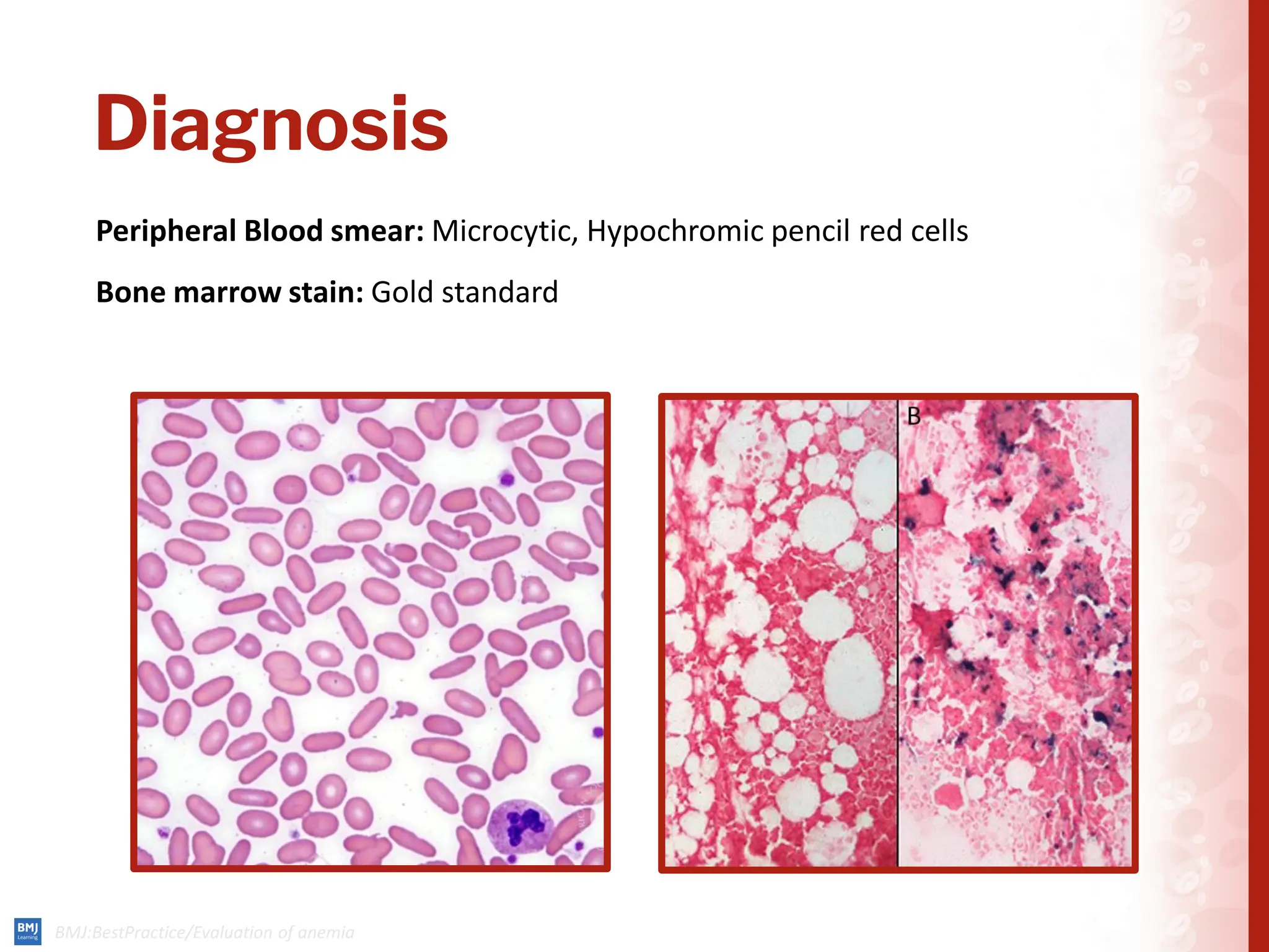 Diagnosis
Peripheral Blood smear: Microcytic, Hypochromic pencil red cells
Bone marrow stain: Gold standard
 