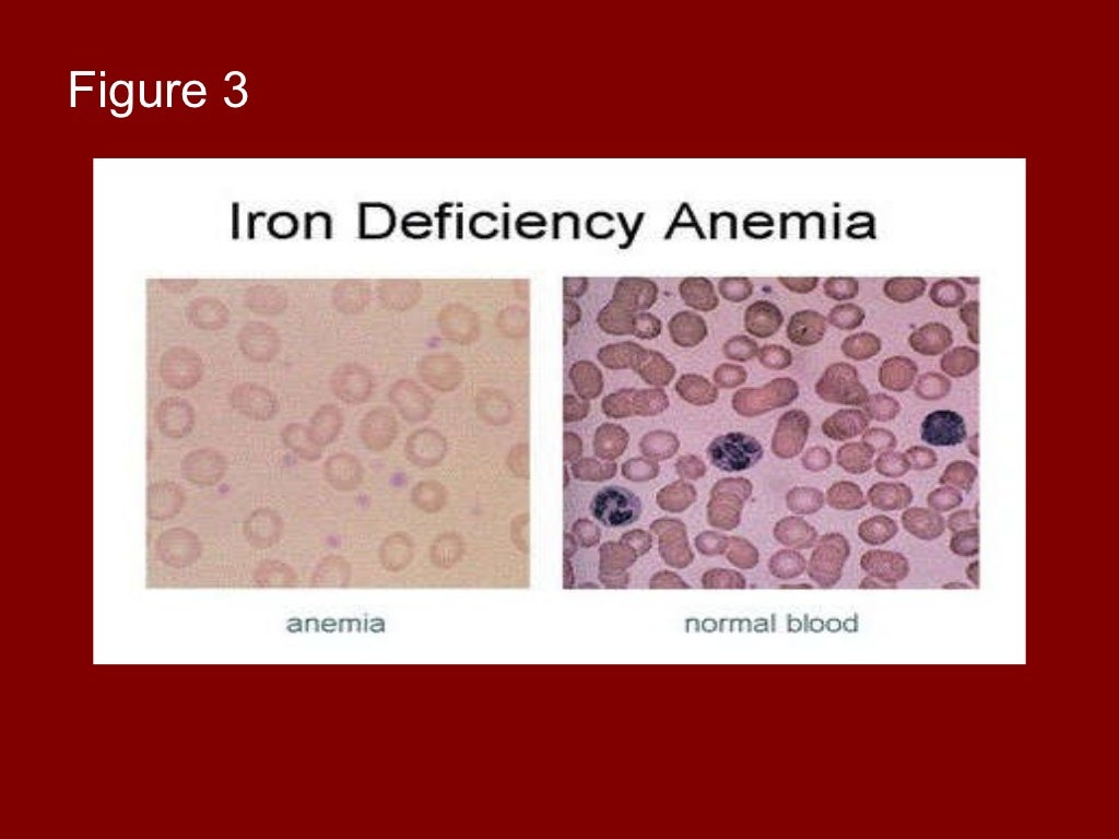 Iron deficiency anemia.