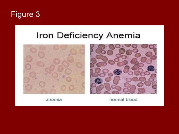 a case of iron deficiency Thyroid science 4(3):cr1-3, 2009 wwwthyroidsciencecom case reports case report: hyperthyroidism, iron-deficiency anemia, and celiac disease. a case of iron deficiency Thyroid science 4(3):cr1-3, 2009 wwwthyroidsciencecom case reports case report: hyperthyroidism, iron-deficiency anemia, and celiac disease.