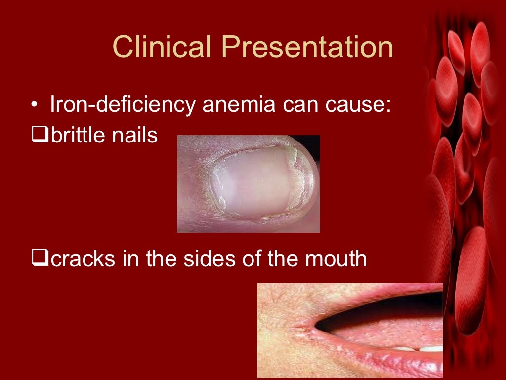 Iron deficiency anemia.