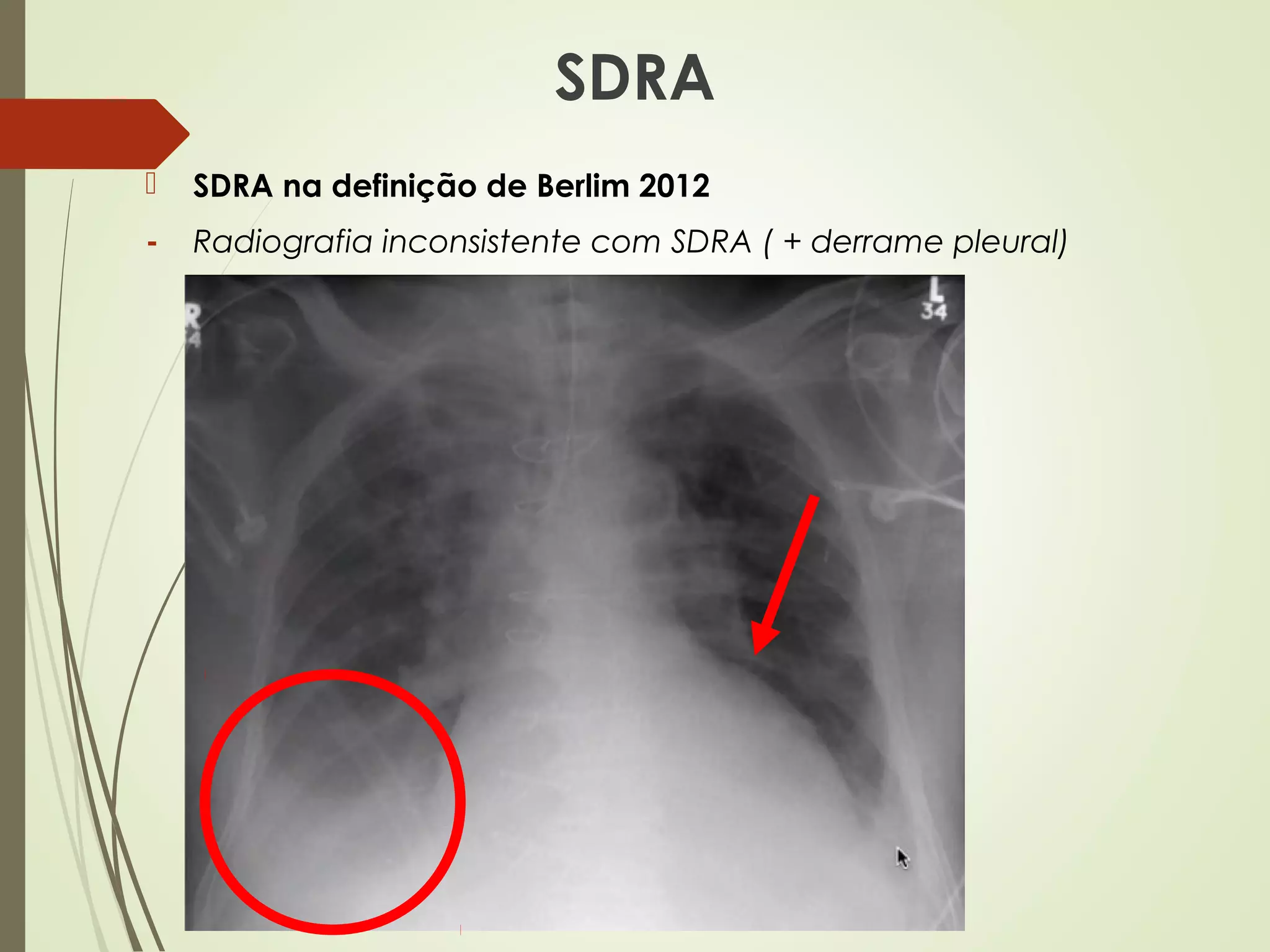 Insufici ncia Respirat ria Aguda IRpA E S ndrome Do Desconforto Insufici ncia Respirat ria Aguda IRpA E S ndrome Do Desconforto