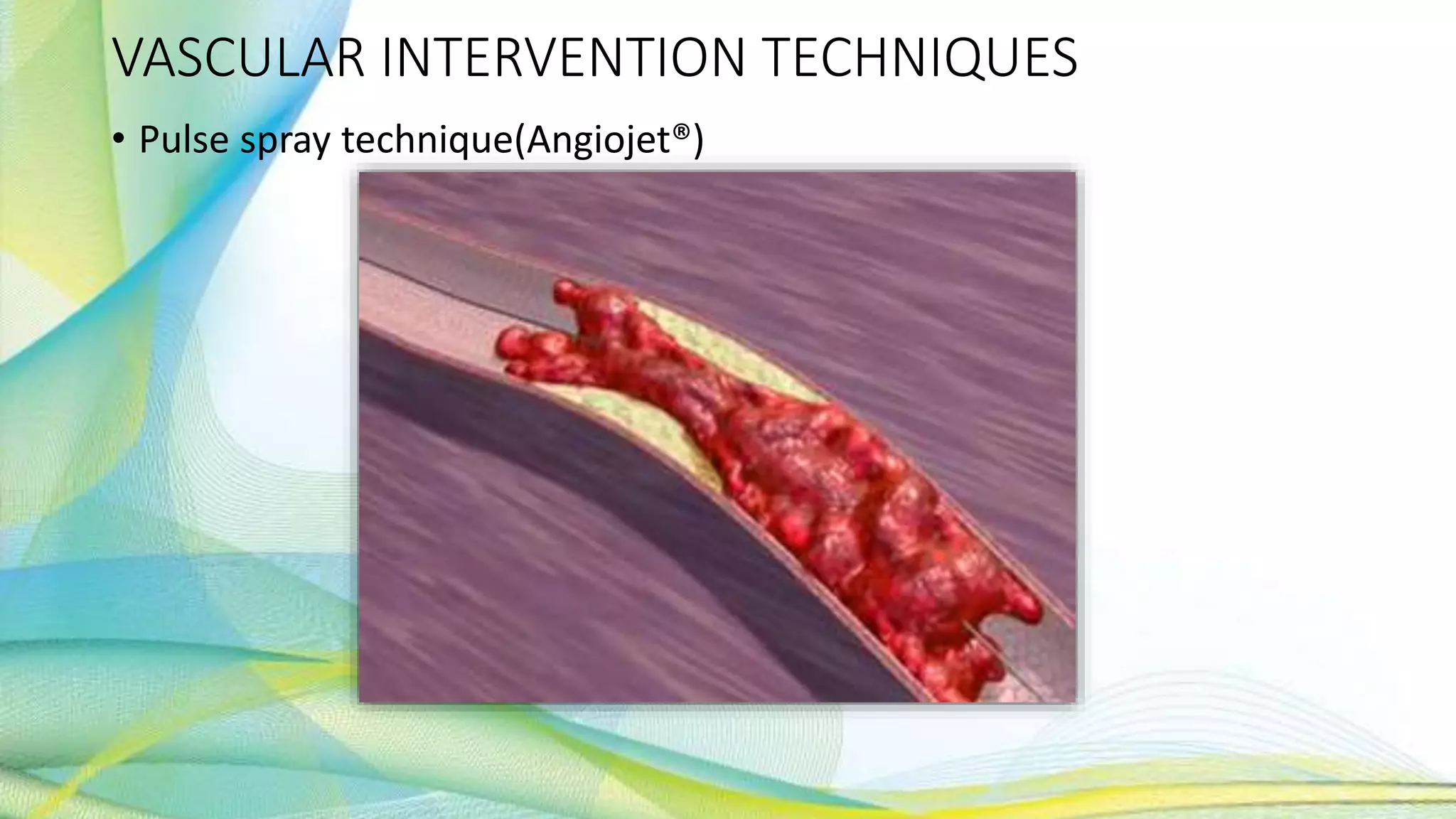 VASCULAR INTERVENTION TECHNIQUES
• Pulse spray technique(Angiojet®)
 