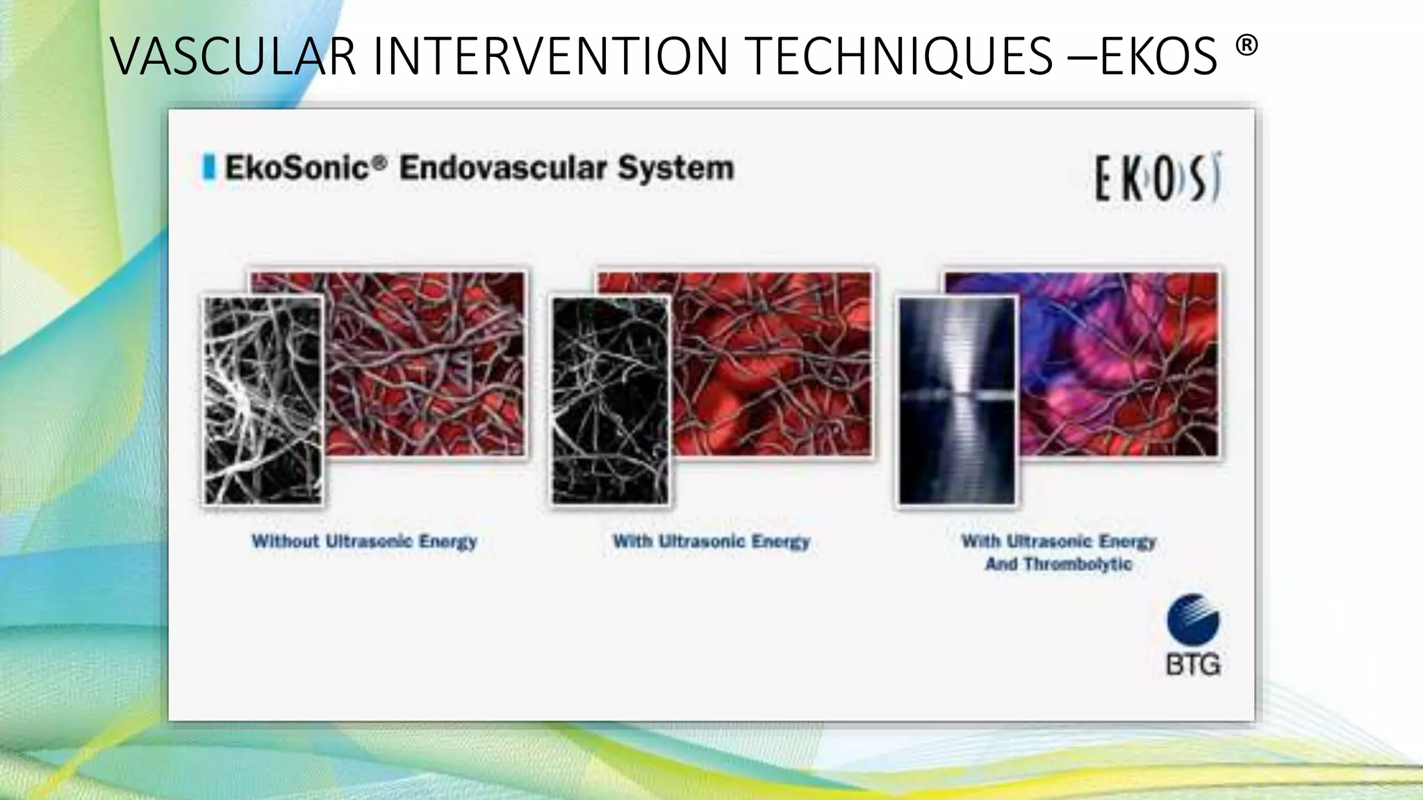VASCULAR INTERVENTION TECHNIQUES –EKOS ®
 