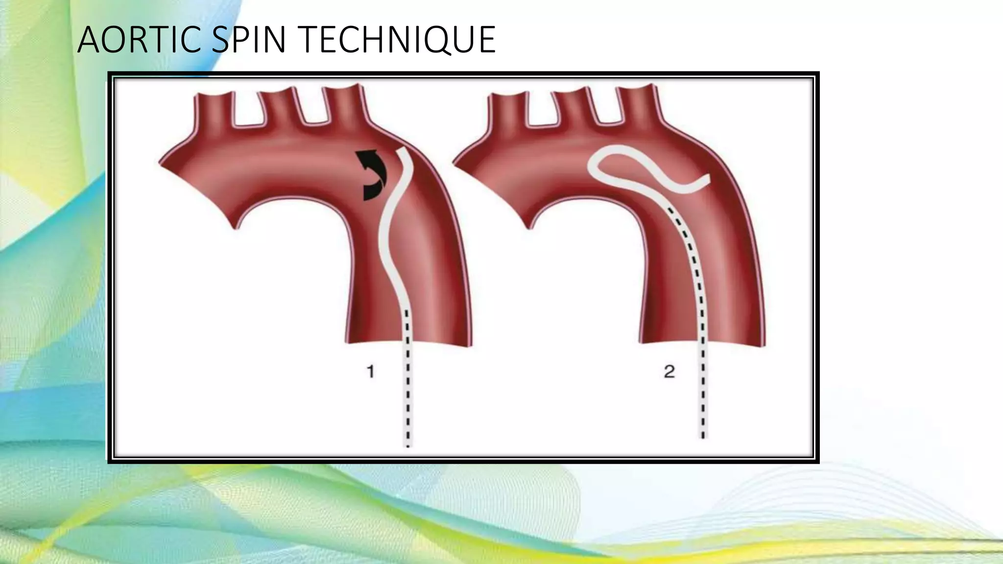 AORTIC SPIN TECHNIQUE
 