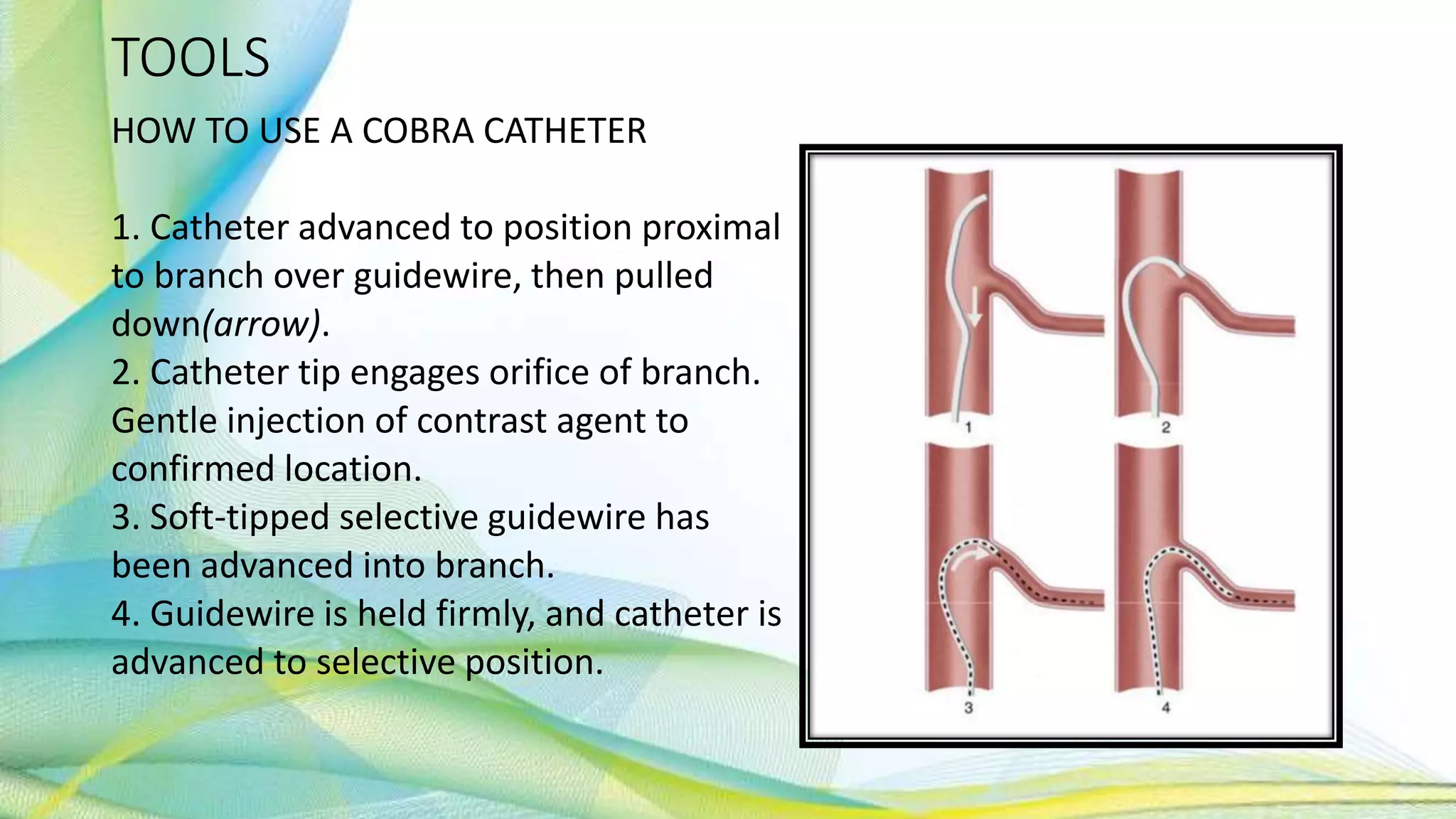 TOOLS
HOW TO USE A COBRA CATHETER
1. Catheter advanced to position proximal
to branch over guidewire, then pulled
down(arrow).
2. Catheter tip engages orifice of branch.
Gentle injection of contrast agent to
confirmed location.
3. Soft-tipped selective guidewire has
been advanced into branch.
4. Guidewire is held firmly, and catheter is
advanced to selective position.
 