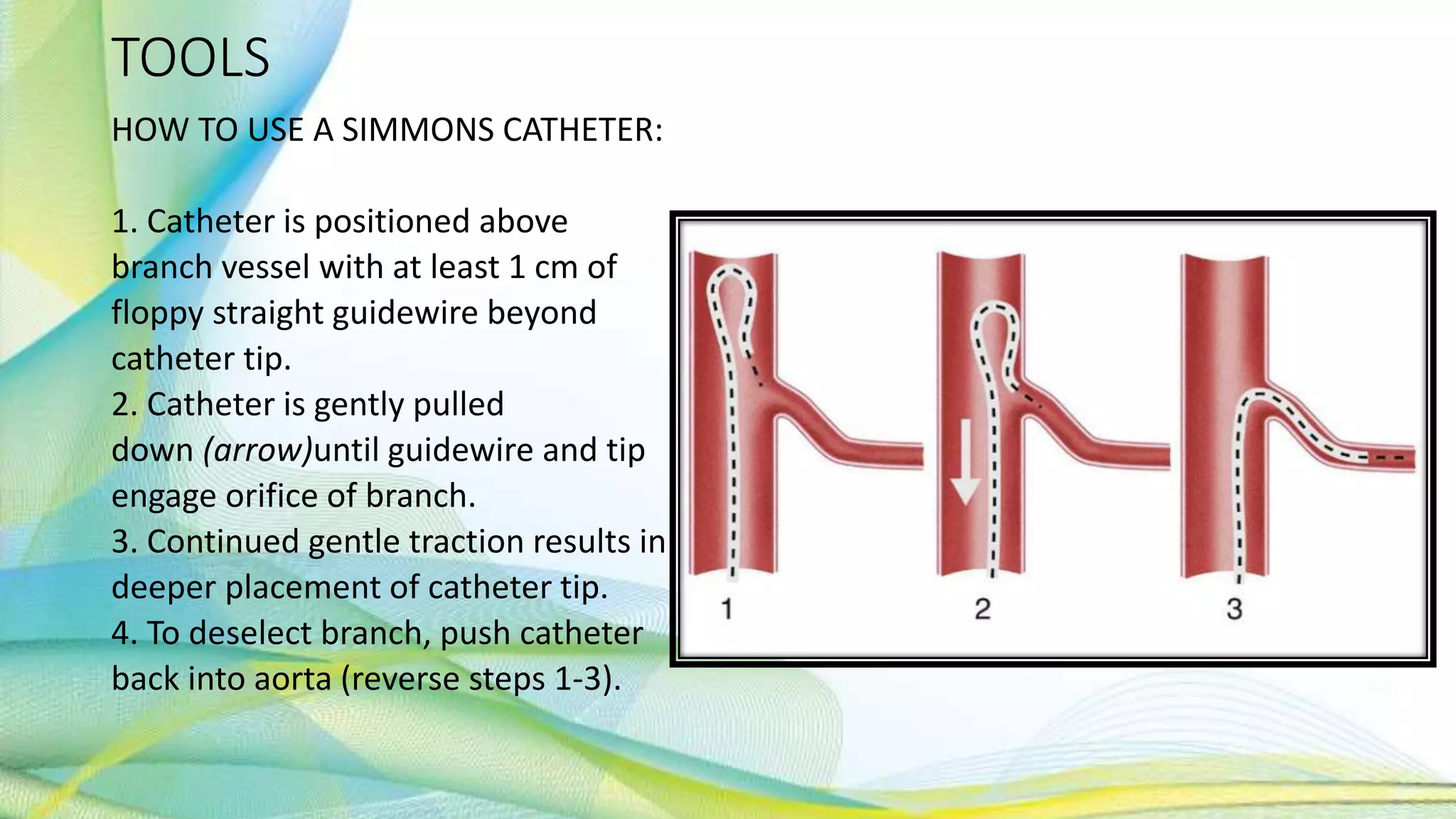 TOOLS
HOW TO USE A SIMMONS CATHETER:
1. Catheter is positioned above
branch vessel with at least 1 cm of
floppy straight guidewire beyond
catheter tip.
2. Catheter is gently pulled
down (arrow)until guidewire and tip
engage orifice of branch.
3. Continued gentle traction results in
deeper placement of catheter tip.
4. To deselect branch, push catheter
back into aorta (reverse steps 1-3).
 