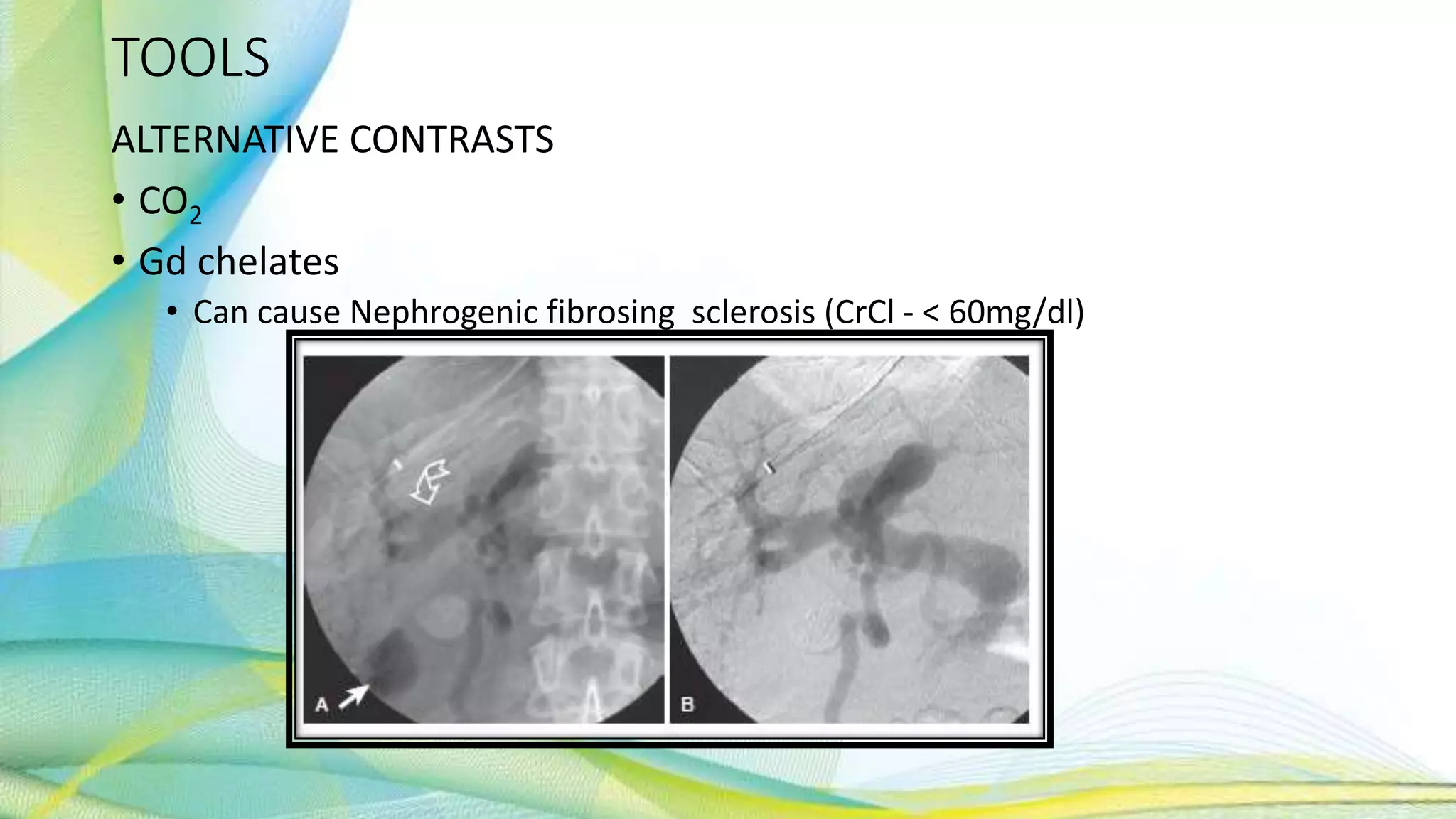 TOOLS
ALTERNATIVE CONTRASTS
• CO2
• Gd chelates
• Can cause Nephrogenic fibrosing sclerosis (CrCl - < 60mg/dl)
 