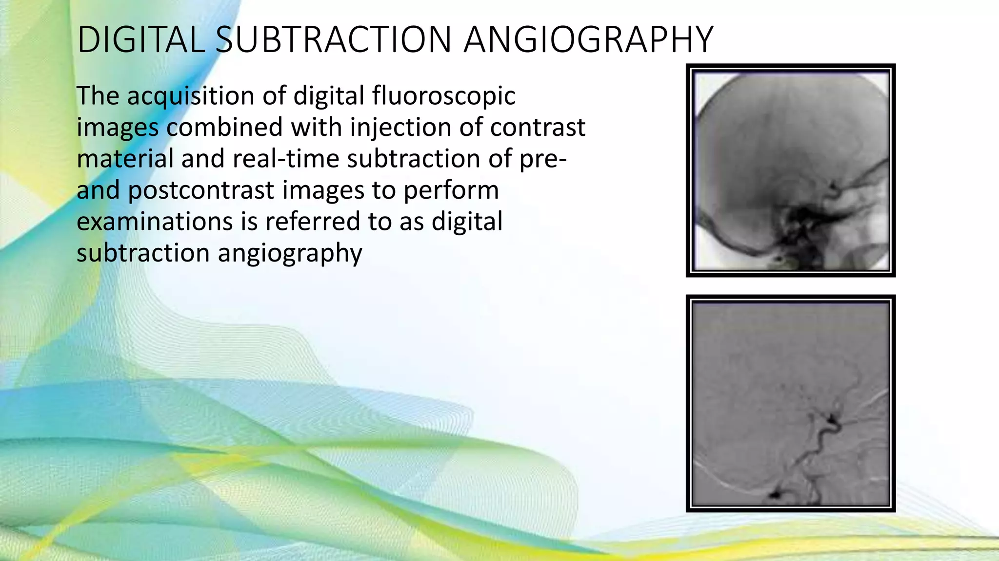 DIGITAL SUBTRACTION ANGIOGRAPHY
The acquisition of digital fluoroscopic
images combined with injection of contrast
material and real-time subtraction of pre-
and postcontrast images to perform
examinations is referred to as digital
subtraction angiography
 