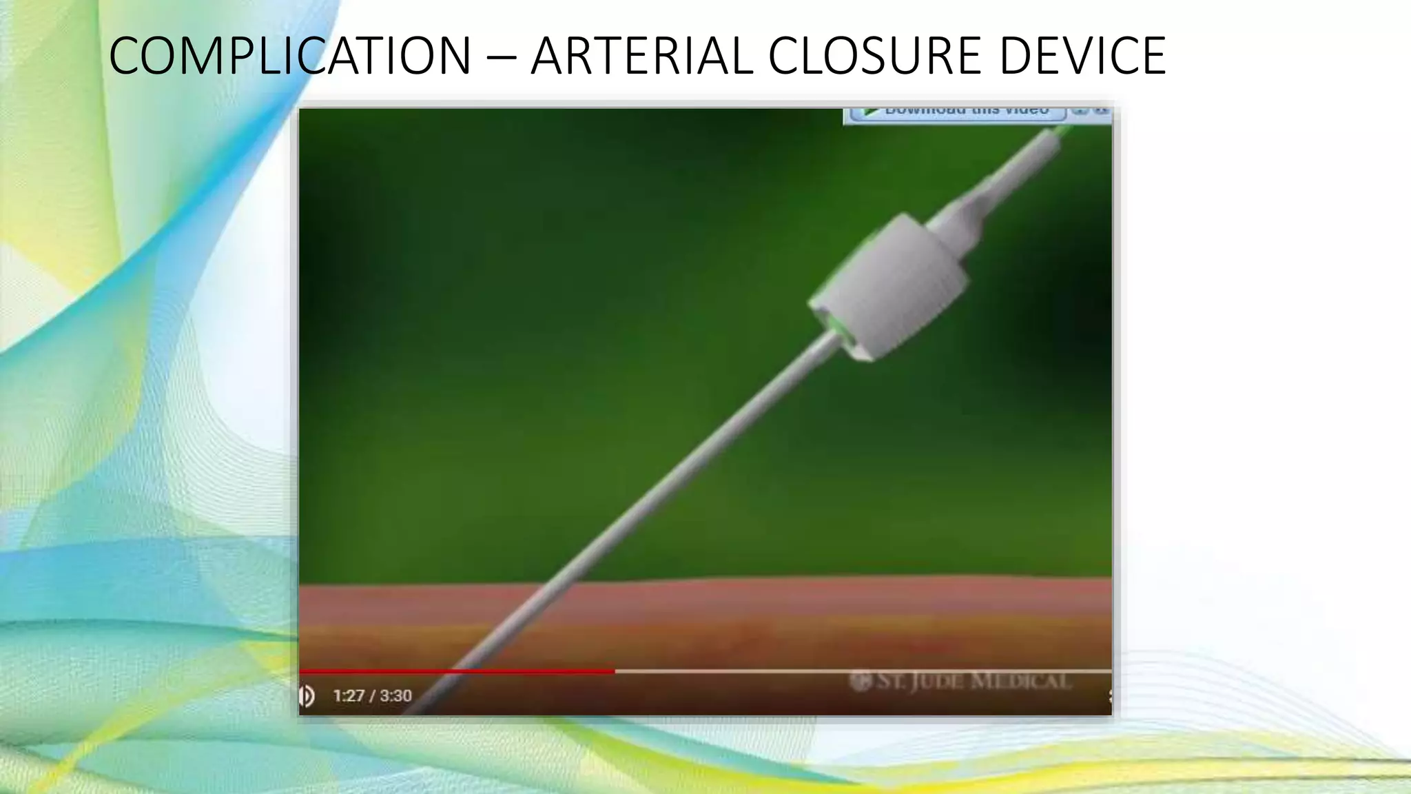 COMPLICATION – ARTERIAL CLOSURE DEVICE
 