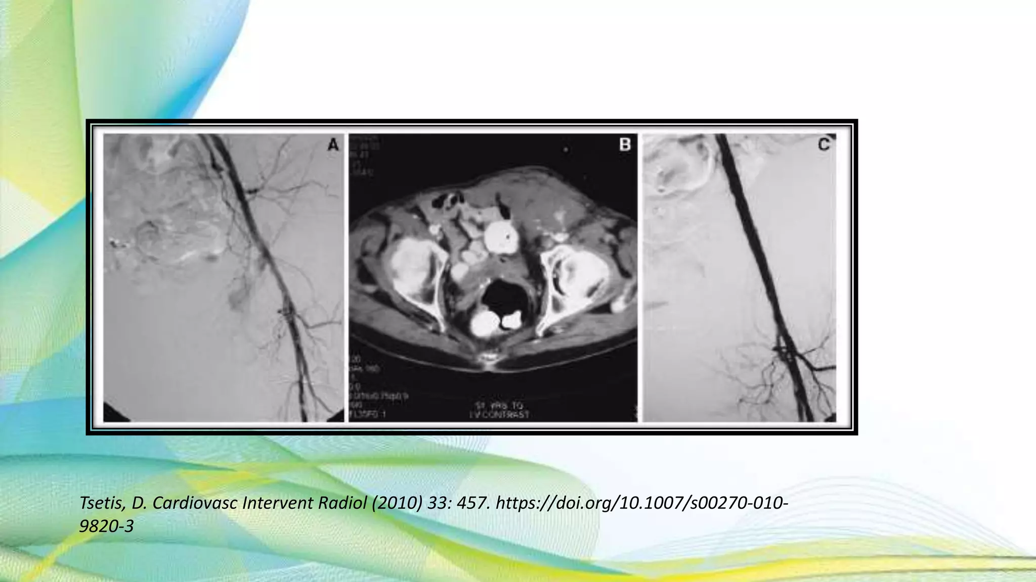 Tsetis, D. Cardiovasc Intervent Radiol (2010) 33: 457. https://doi.org/10.1007/s00270-010-
9820-3
 