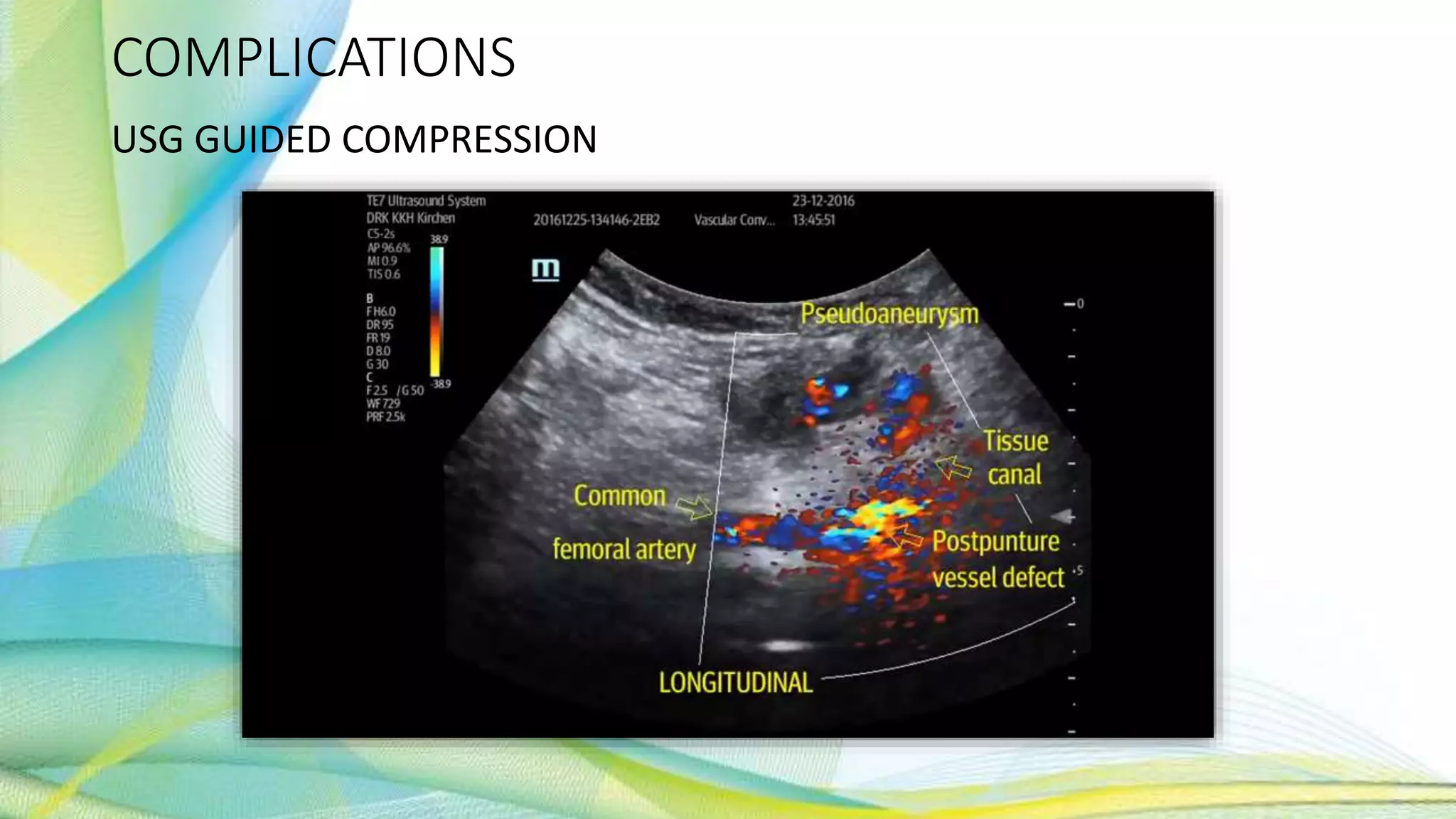 COMPLICATIONS
USG GUIDED COMPRESSION
 