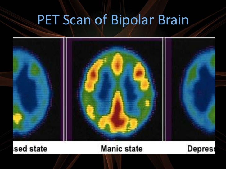 adhd is a neurological brain disorder adhd is a neurological brain disorder