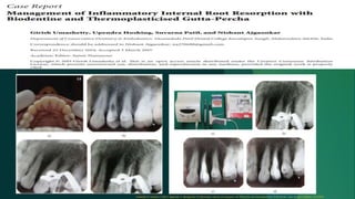 Umashetty G, Hoshing U, Patil S, Ajgaonkar N. Management of inflammatory internal root resorption with Biodentine and thermoplasticised Gutta-Percha. Case reports in dentistry. 2015;2015.
 