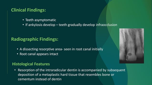 INTERNAL ROOT RESORPTION AND ITS CLINICAL MANAGEMENT | PPTX | Dental ...