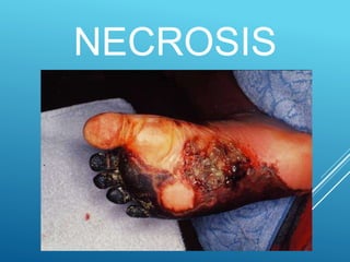 NECROSIS
 