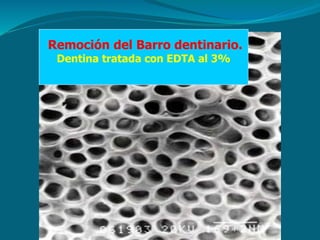 Remoción del Barro dentinario.
Dentina tratada con EDTA al 3%
 
