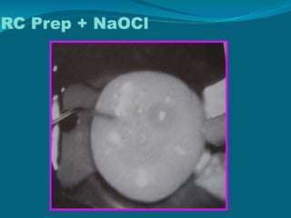 RC Prep + NaOCl
 