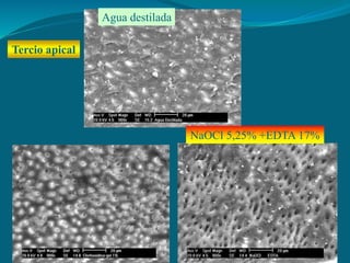 Gel de Clx al 1% NaOCl 5,25% +EDTA 17%
Agua destilada
Tercio apical
 