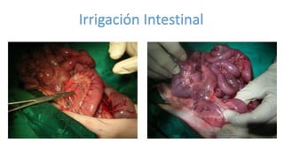 Irrigación Intestinal
 
