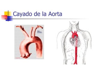 Cayado de la Aorta 