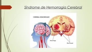 Síndrome de Hemorragia Cerebral 
 