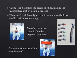 Inserting the ozone
cannula into the
prepared root canal
Treatment with ozone with a
complete seal
 