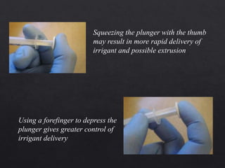 Squeezing the plunger with the thumb
may result in more rapid delivery of
irrigant and possible extrusion
Using a forefinger to depress the
plunger gives greater control of
irrigant delivery
 