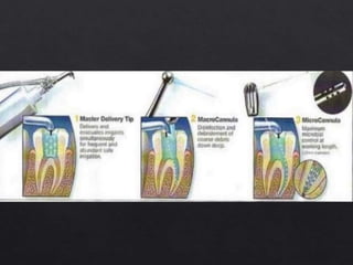 Irrigants and Irrigation Devices