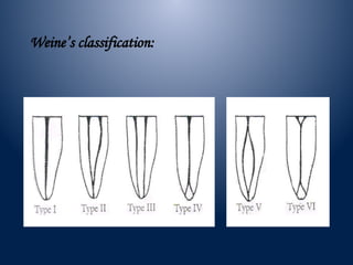Weine Classification Advanced Techniques and Challenges in Root Canal Irrigation and ...