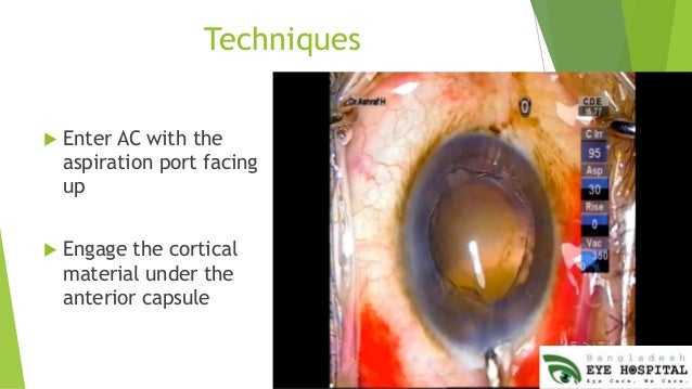 phacoemulsification