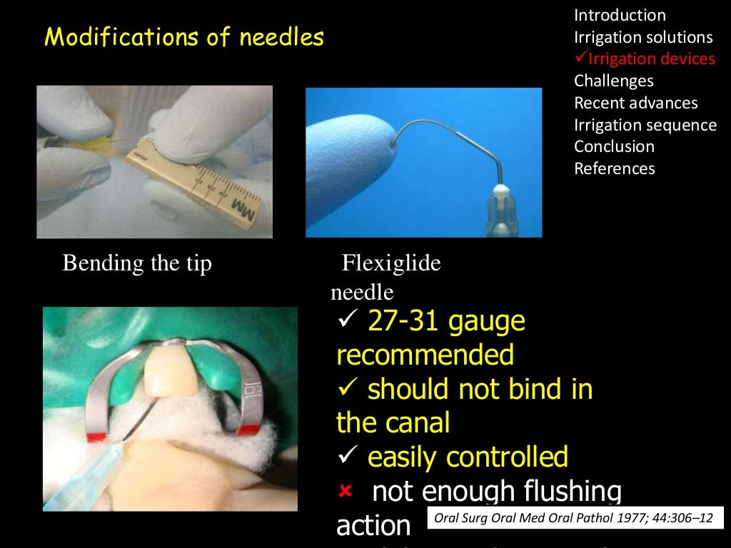 Irrigation in endodontics